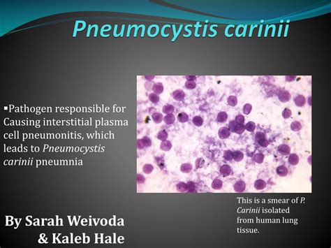 Ppt Pneumocystis Carinii Powerpoint Presentation Free Download Id1988078