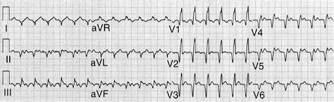 Wide Complex Tachycardia Circulation