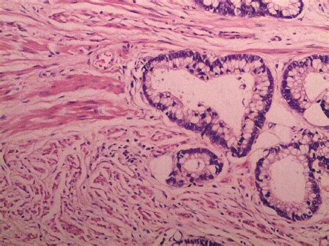 Management Of Primary Adenocarcinoma Of The Female Urethra Report Of Two Cases And Review Of