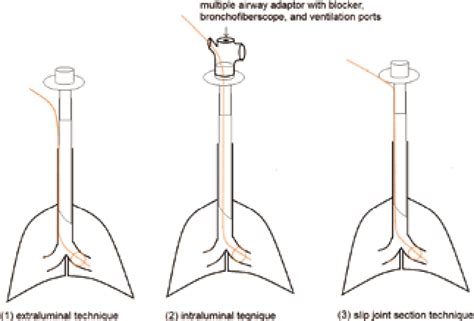 Figure 1 from Insertion of a Fogarty catheter through a slip joint ...