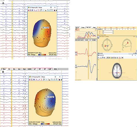 JLE Epileptic Disorders Classification Of Electrical Status