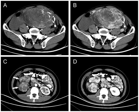 Clinicopathological Findings In A Case Series Of Abdominopelvic