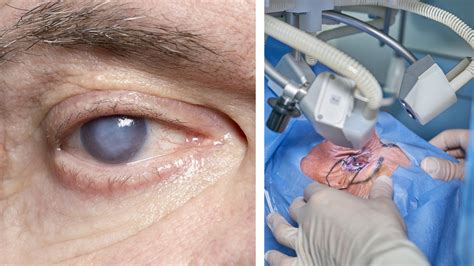 Cataract Surgery Types Pros And Cons Expert Explains Everything You