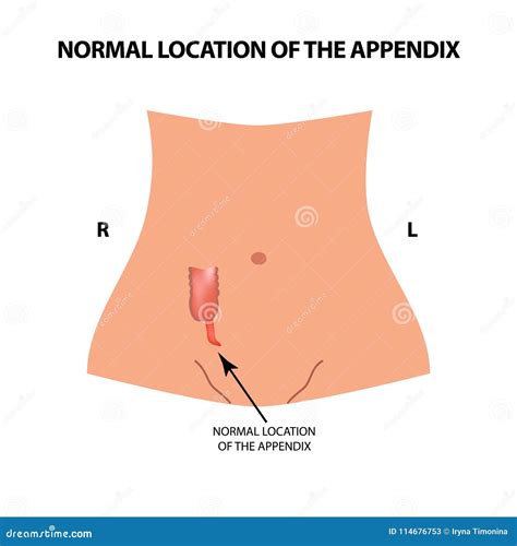 The Normal Location Of The Appendix Vector Illustration On Isolated