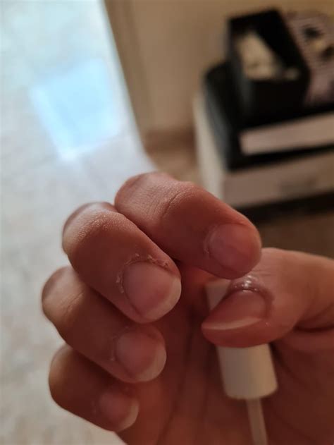 How Do I Stop Cuticle Skin Peeling R Nails