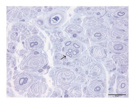 Sural Nerve Biopsy Of A Mixed Myelin Axonal Damage Cmt1a Patient