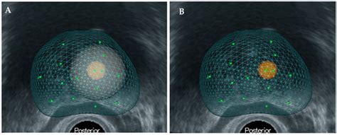 Diagnostics Free Full Text Perilesional Targeted Biopsy Combined With Mri Trus Image Fusion