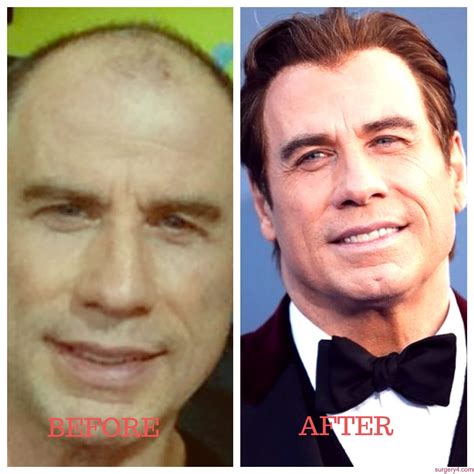 John Travolta Plastic Surgery Photos Before And After ⋆ Surgery4