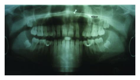 Oral Orthopantomogram Opg Showing Well Defined Radiolucent Cyst