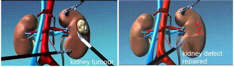 Robotic Partial Nephrectomy Chin Chong Min Urology And Robotic Surgery