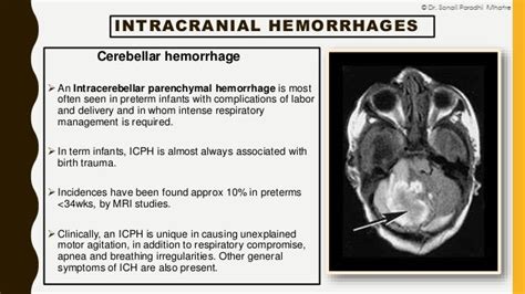 Neonatal Intracranial Hemorrhage By Dr Sonali Mhatre