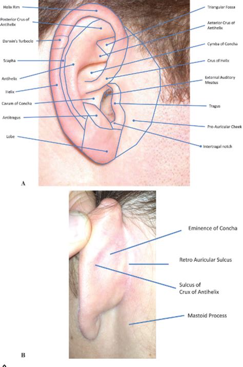 Figure 3 from Surface Anatomy of the Ear | Semantic Scholar