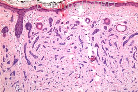 Desmoplastic Trichoepithelioma