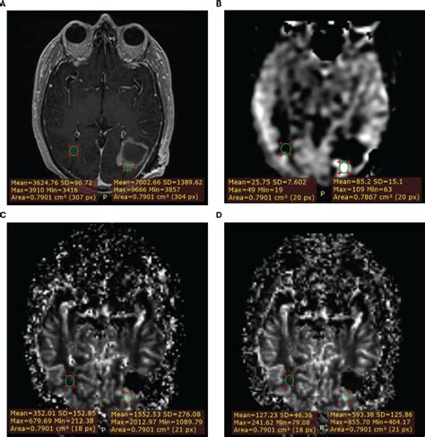 Frontiers Diagnostic Accuracy Of Arterial Spin Labeling In Comparison