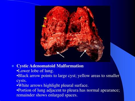 Ppt Congenital Cystic Adenomatoid Malformation Ccam Of The Lung Powerpoint Presentation Id