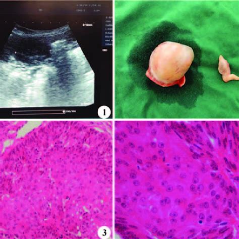 Testis Mixed Germ Cell Sex Cord Stromal Tumour Trans Abdominal