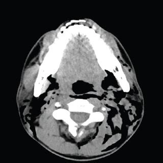 (a) Chest x-ray with pneumomediastinum with subcutaneous air in the ...