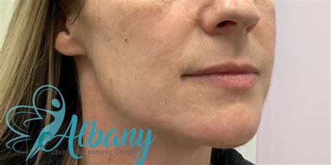 Jawline Fillers Case No Albany Cosmetic And Laser Centre