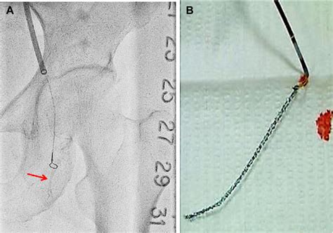 Retrieval of the lost coronary stent. (A) The stent (arrow) was caught ...