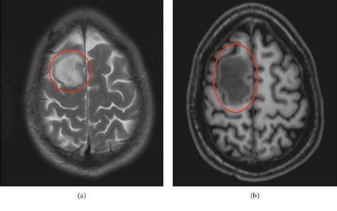 Figure 1 from An Unusual Case of CMV/EBV Ventriculoencephalitis with ...