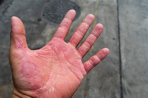 Occupational Allergic Contact Dermatitis Caused By Solvent 55 Off