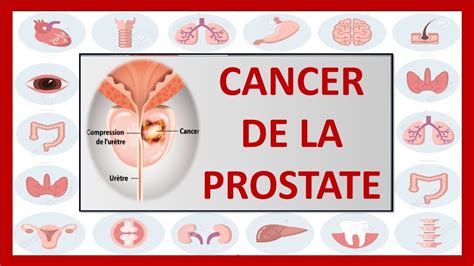 UROLOGIE CANCER DE LA PROSTATE l adénocarcinome prostatique YouTube