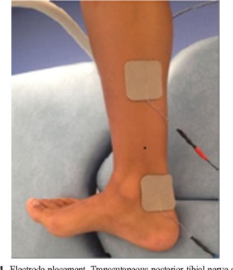 Transcutaneous Posterior Tibial Nerve Stimulation Evaluation Of A