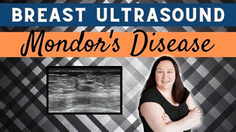 Breast Ultrasound Pathology Gallery Mondor S Disease Youtube