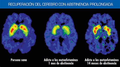 El Cerebro Adicto Cómo Las Drogas Anulan Las Capacidades Humanas Infobae