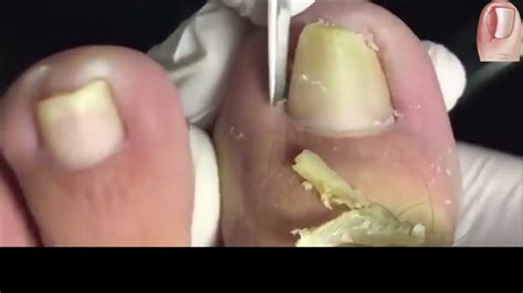 How To Cut Thick Toenails Satisfying Toenail Cleaning Fps Youtube