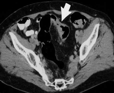 msct  colon cancer cecum transverse colon arrows