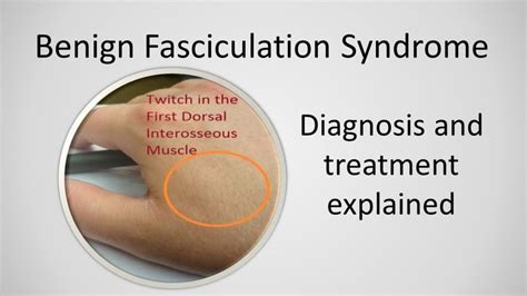 Articles 320388 Php Syndrome Treatment Muscle Twitching