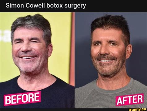 Simon Cowell botox surgery BEFORE AFTER - iFunny