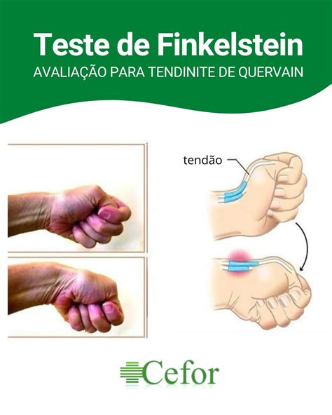 Clínica - 🖐️ TESTE DE FINKELSTEIN: AVALIAÇÃO PARA TENDINITE DE QUERVAIN 🏥 O Teste de Finkelstein