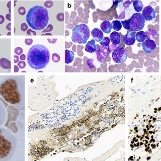 Example Of Primary Effusion Lymphoma With Expression Of T Cell Markers