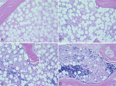 Examples Of Biopsies With Different Degrees Of Bone Marrow Iron