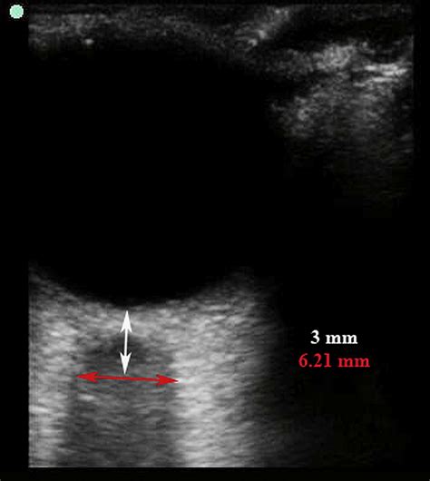 Optic Neuritis Diagnosed By Bedside Emergency Physician−performed Ultrasound A Case Report