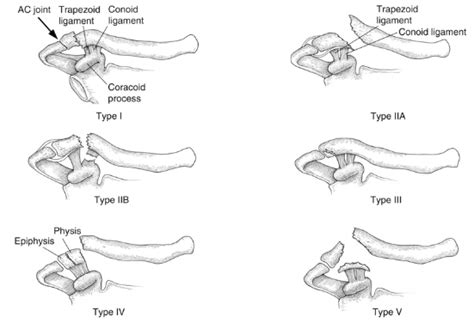 Clavicle Fracture Grading