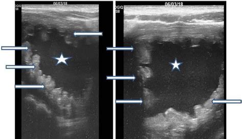 Sagittal And Transverse B Mode Ultrasound Scan Of The Pelvis Showing