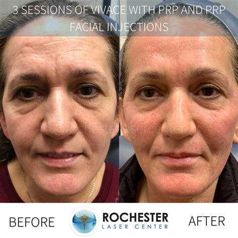 Microneedling Before And After Brown Spots Before And After