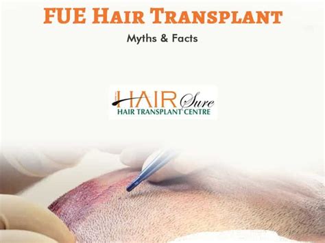 Fue Hair Transplant Myths And Facts Cyber Hairsure