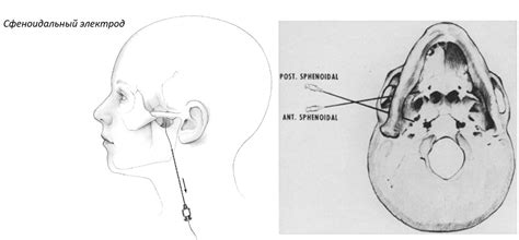 ЭЭГ. Электроды | Электроэнцефалография | Дзен
