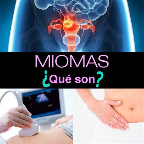 Miomas uterinos causas síntomas y tratamiento Miomas uterinos