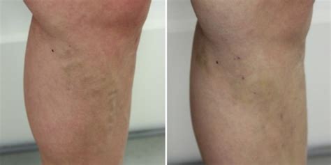 EVLA Varicose Vein Removal London Vein Centre