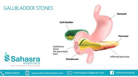 Gallbladder Stones Symptoms Causes And Treatment Ppt