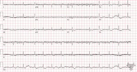 Digoxin Toxicity Ecg Stampede