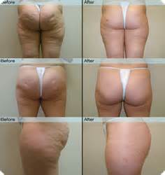 Truth About Cellulite Review Exposes Joey Atlas Breakthrough