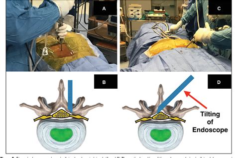 Figure From Full Endoscopic Interlaminar Surgery Of Lumbar Spine