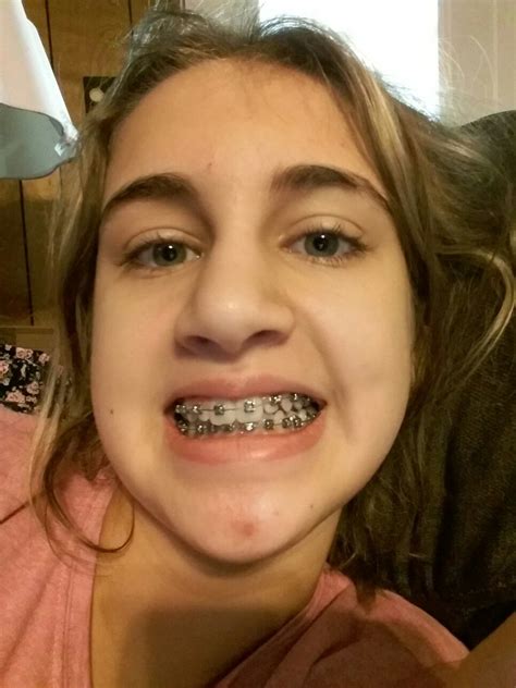 Pin By Ante Bubalo On Quick Saves Braces Girls Braces Colors