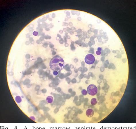 Figure 4 From A Rare Cause Of Secondary Hemophagocytic